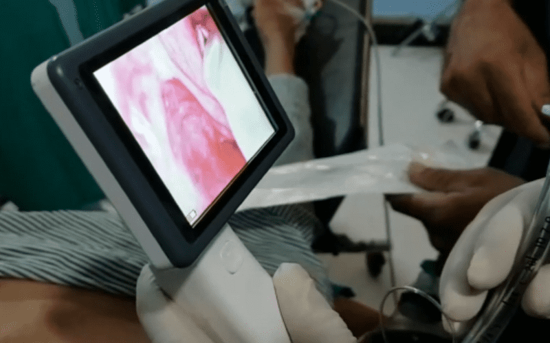 Video Laryngoscope in Surgery